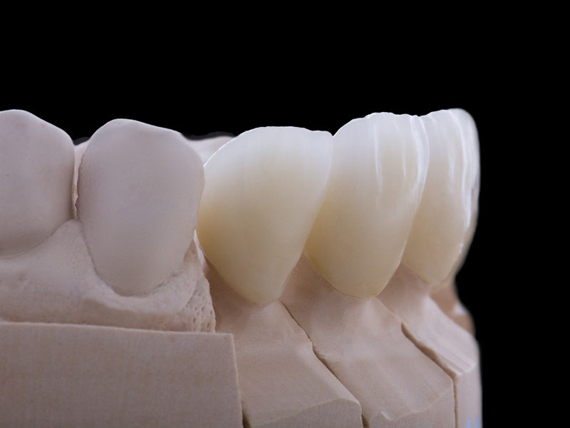 cosmetic dental crowns dentist cosmetic restoration