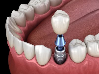 Single Tooth Implant