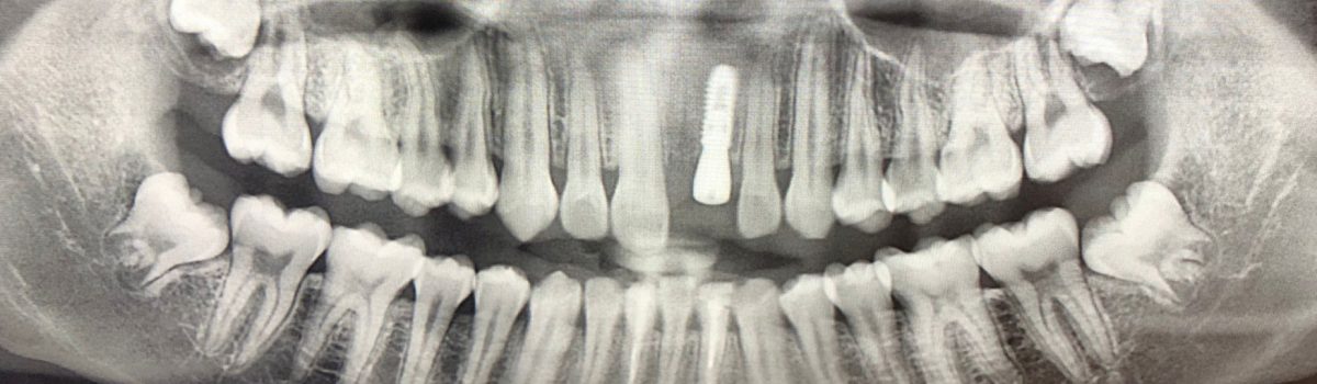 Panoramic CBCT Xray Implant