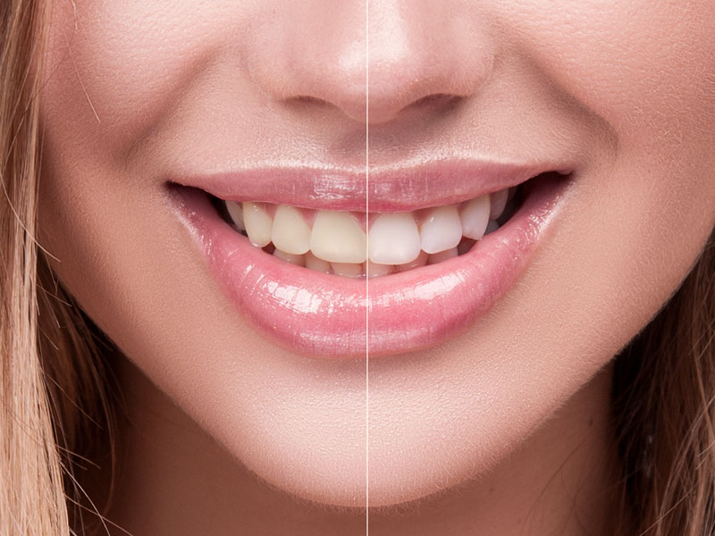 teeth whitening shiny lips girl smiling